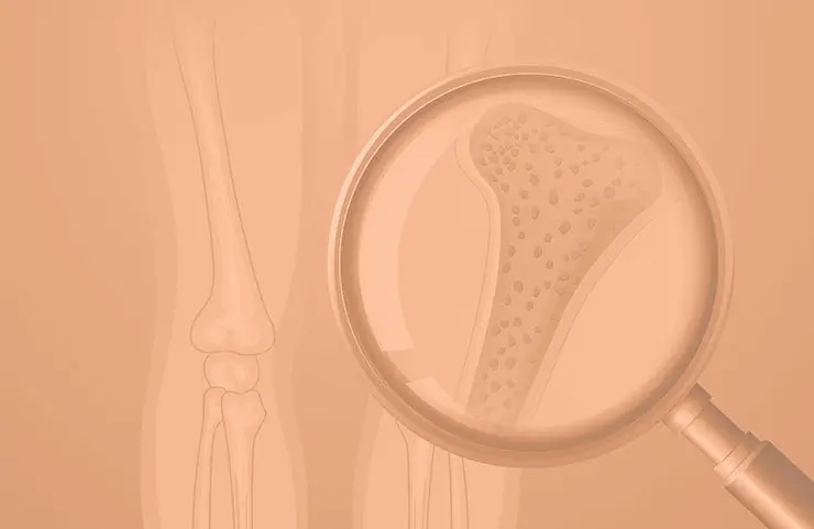 tratamento-osteoporose-brasilia